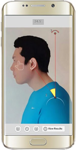 Forward Head Posture (FHP)