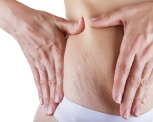 Natural Stretch Marks Removal
